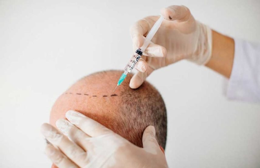 Washing Your Hair After a Hair Transplant What You Should Know