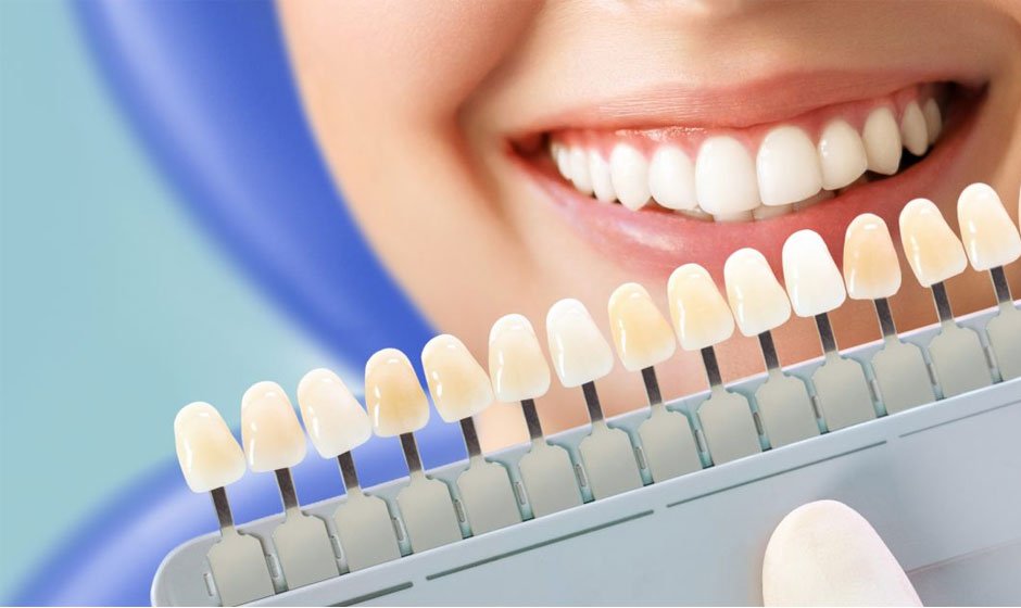 A Guide to Safe and Effective Dental Whitening