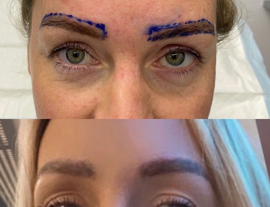 Why Did Getting an Eyebrow Transplant Change Your Life