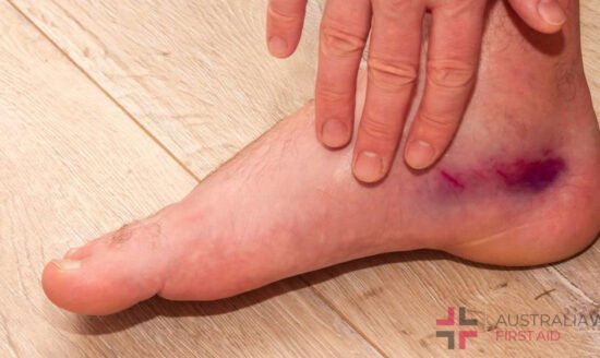 Overuse Injuries in Sports