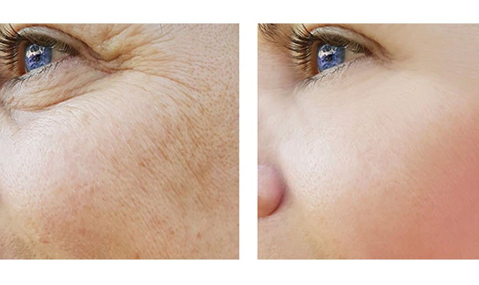 10 Skin Rejuvenation Treatments That Can Make You Look Younger
