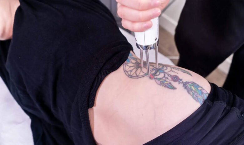 Say Goodbye to Unwanted Ink with Precision Tattoo Removal in Vancouver