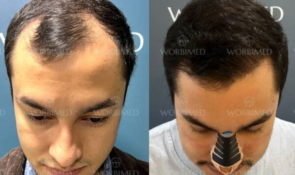 Medical Tourism and DHI Hair Transplants
