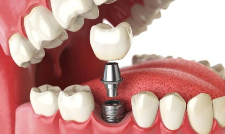 Who Should Perform Dental Implant Placement?