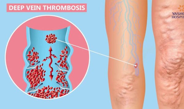 Deep Vein Thrombosis Explained