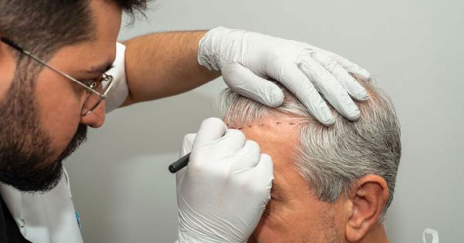 isahairtransplantincolombiarightforyouwhatpatientsshouldknowfirst